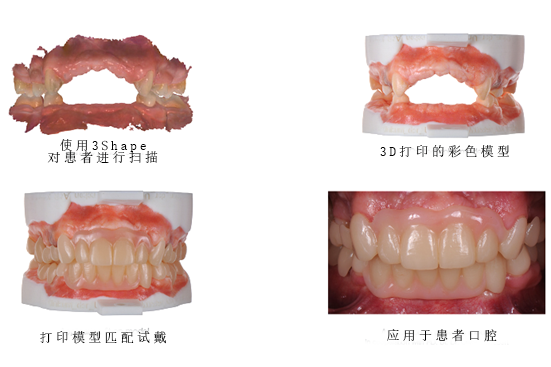 3Shape彩色工作流程，讓牙齒假體越來(lái)越“真”！