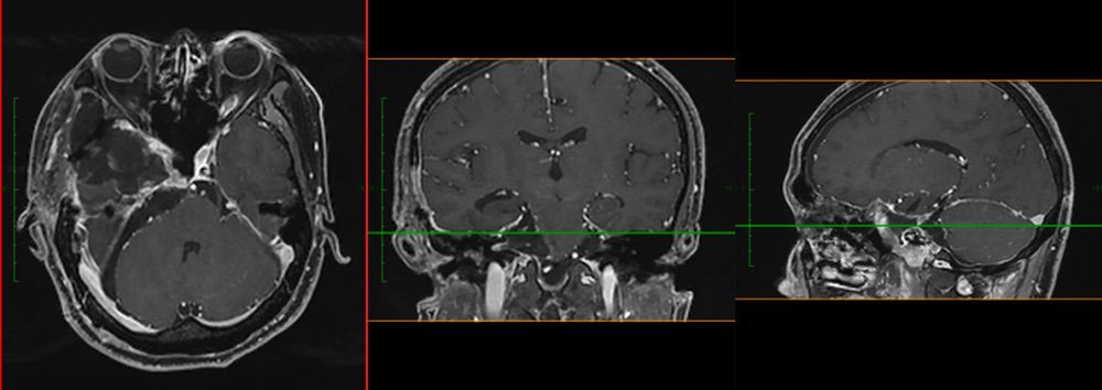 3D打印精準手術切除顱內拳頭大腫瘤